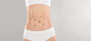 Tummy Tuck Procedure Near Me in Colmar, PA